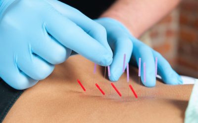 Dry Needling